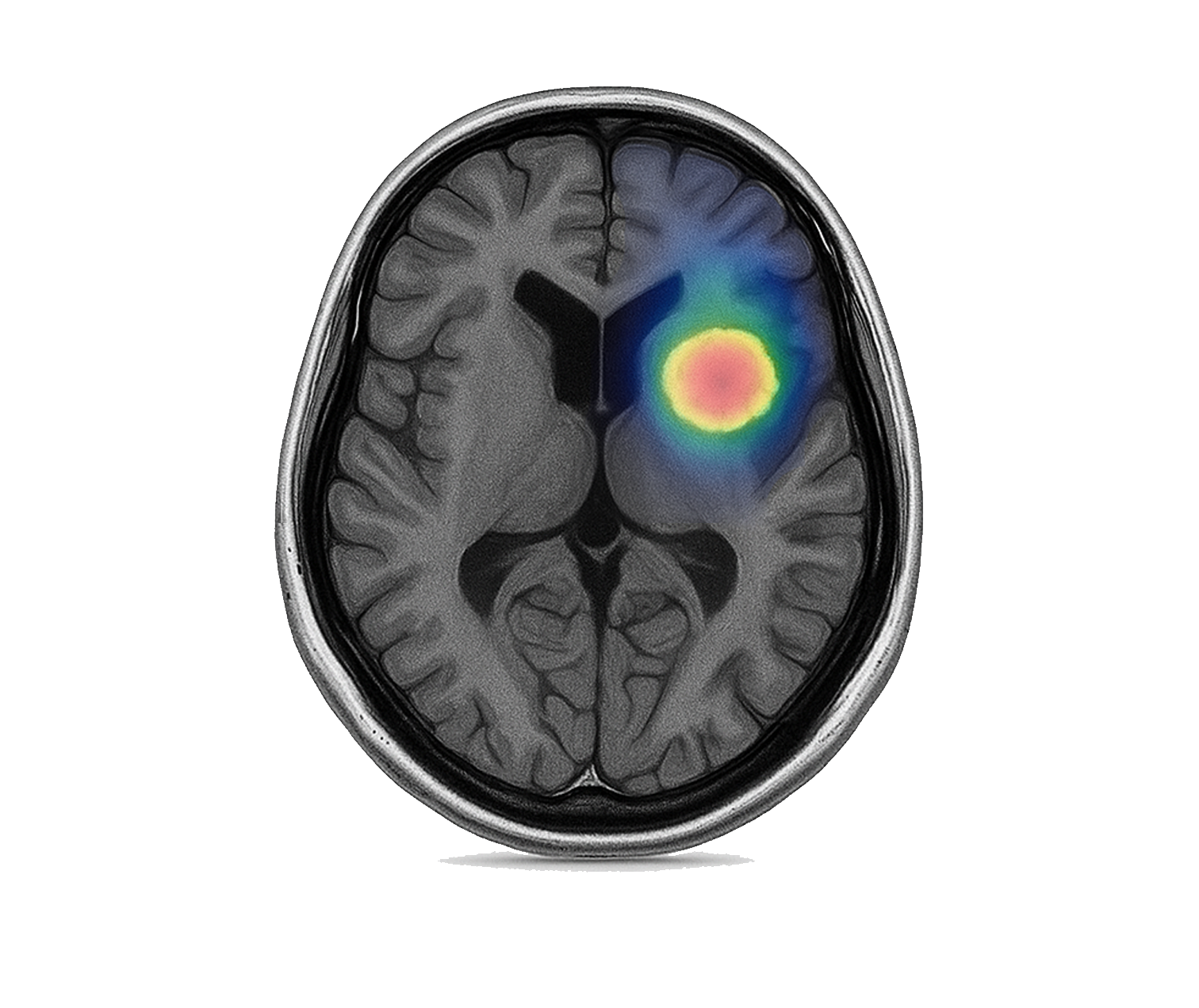 Quantum Computing for MRI Classifiction